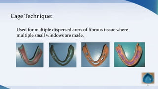 80
Cage Technique:
Used for multiple dispersed areas of fibrous tissue where
multiple small windows are made.
 