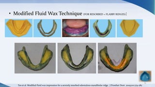 • Modified Fluid Wax Technique (FOR RESORBED + FLABBY RIDGES):
81
Tan et al. Modified fluid wax impression for a severely resorbed edentulous mandibular ridge. J Prosthet Dent. 2009;101:279-282
 