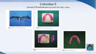 Colvenkar S
Journal of Prosthodontics 19 (2010) 161–165 c 2009
84
 