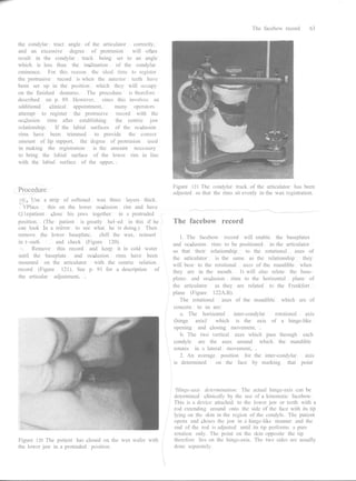 Registration Rims Complete denture prosthetics | PDF