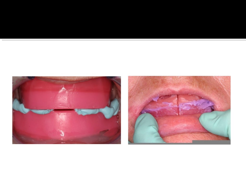 Complete denture prosthodontics step by step