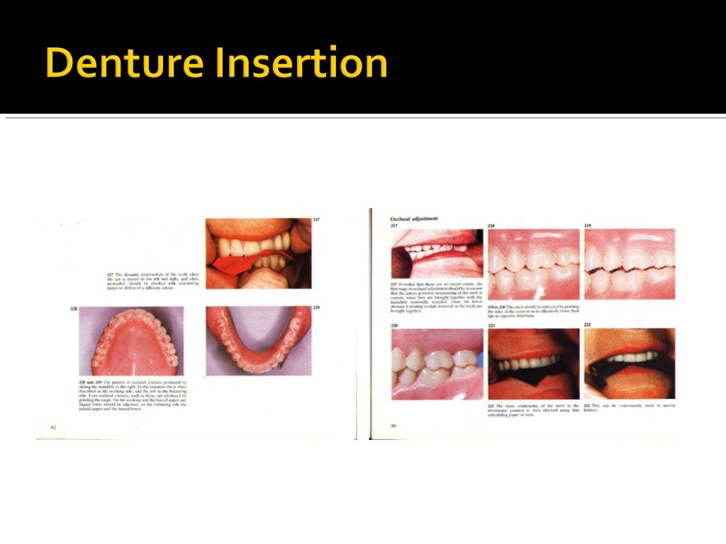 Complete denture prosthodontics step by step