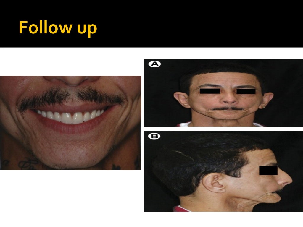 Complete denture prosthodontics step by step