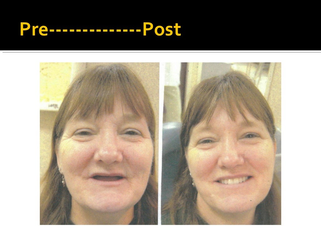 Complete denture prosthodontics step by step