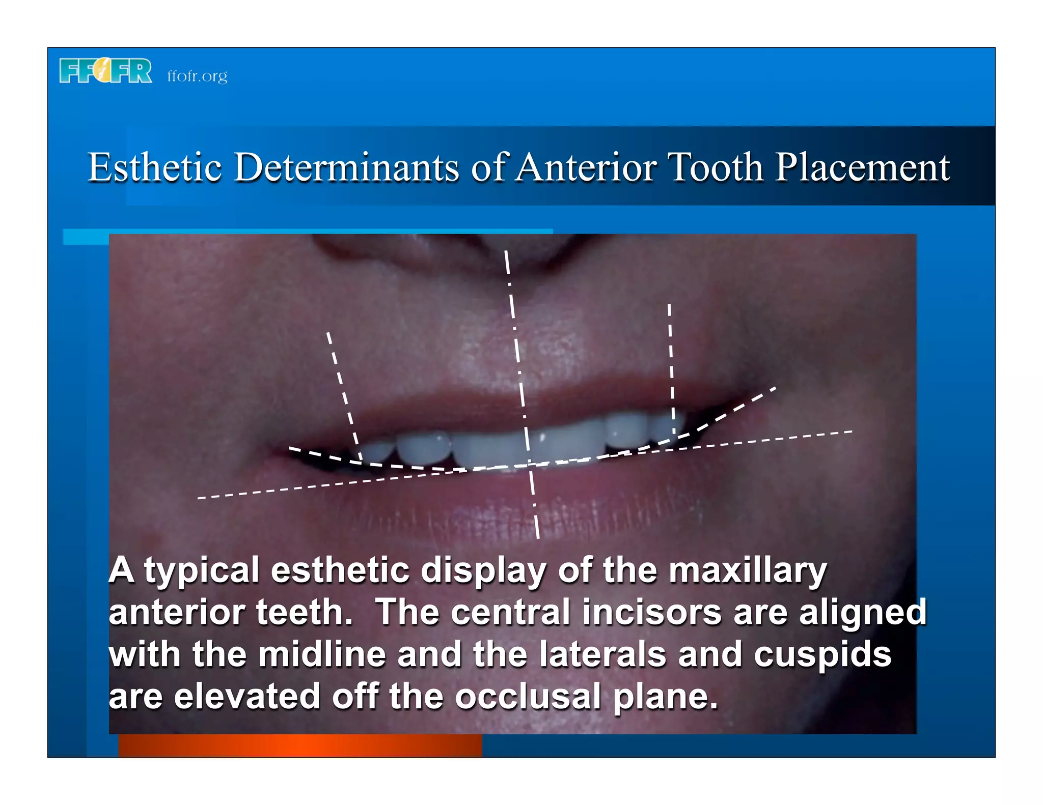 Complete dentures 16.occlusal schemes lingualized occlusion PPT