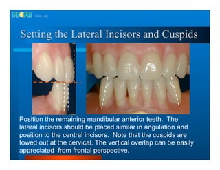 Complete dentures 16.occlusal schemes lingualized occlusion | PDF