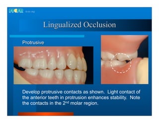 Proclusive Complete dentures 16.occlusal schemes lingualized occlusion | PDF