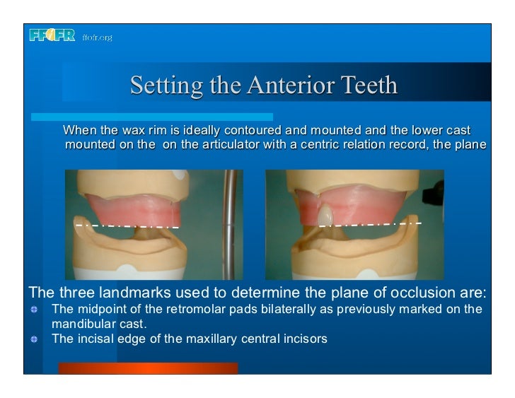 Complete dentures 16.occlusal schemes lingualized occlusion
