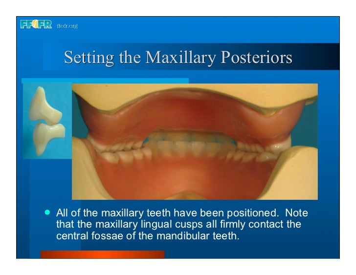 Complete dentures 16.occlusal schemes lingualized occlusion