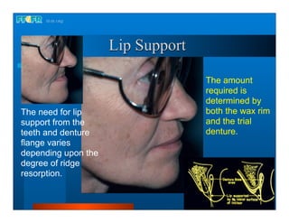 Complete dentures 16.occlusal schemes lingualized occlusion | PDF