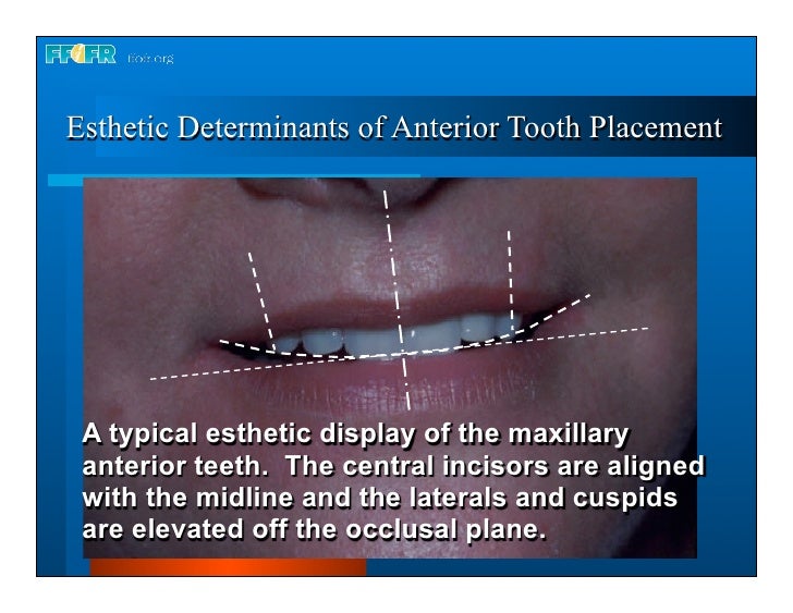 Complete dentures 16.occlusal schemes lingualized occlusion