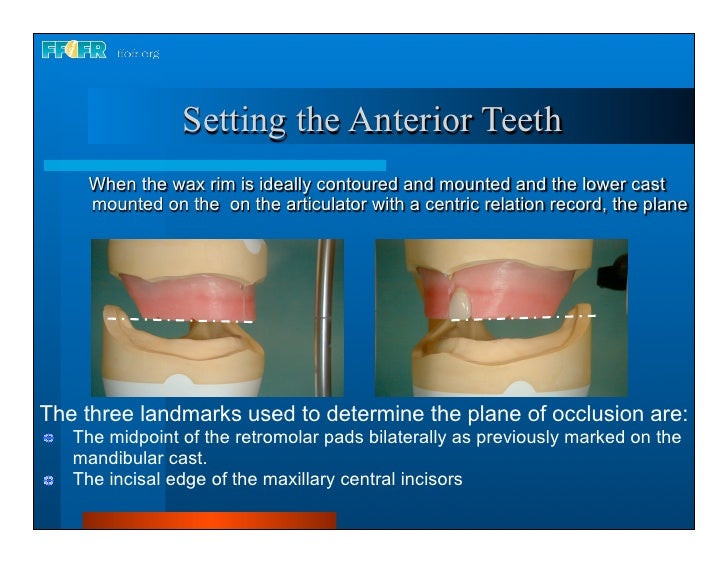 Complete dentures 16.occlusal schemes lingualized occlusion