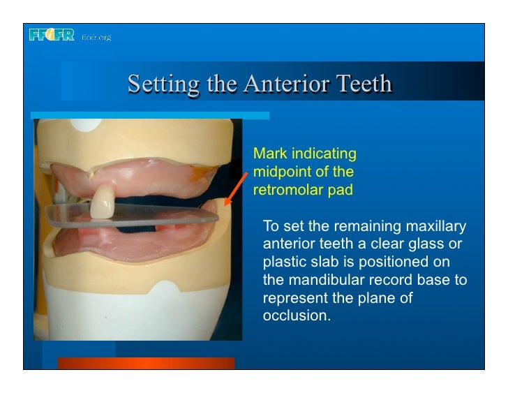 Complete dentures 16.occlusal schemes lingualized occlusion