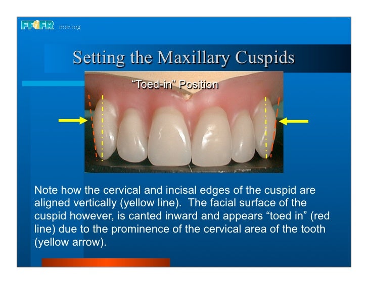 Complete dentures 16.occlusal schemes lingualized occlusion