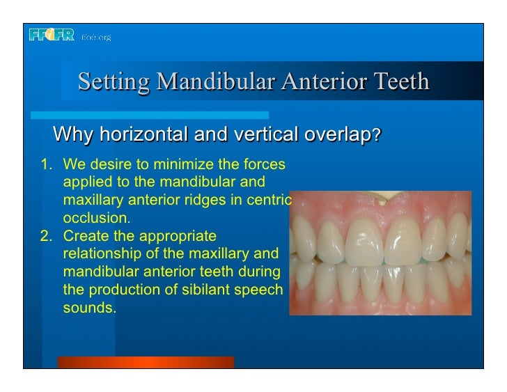 Complete dentures 16.occlusal schemes lingualized occlusion
