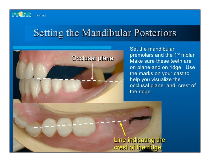 Complete dentures 16.occlusal schemes lingualized occlusion