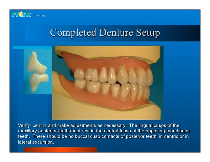 Complete dentures 16.occlusal schemes lingualized occlusion