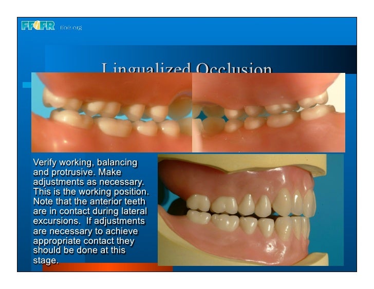 Complete dentures 16.occlusal schemes lingualized occlusion
