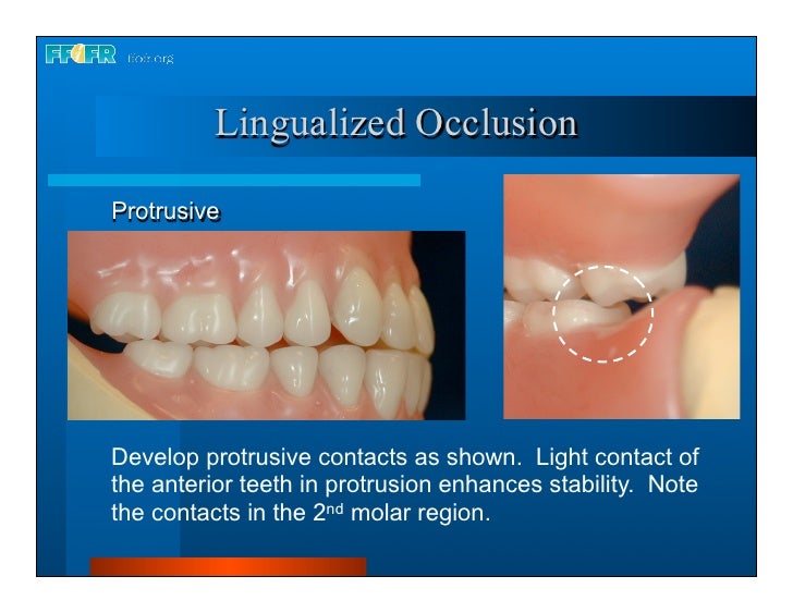 Complete dentures 16.occlusal schemes lingualized occlusion