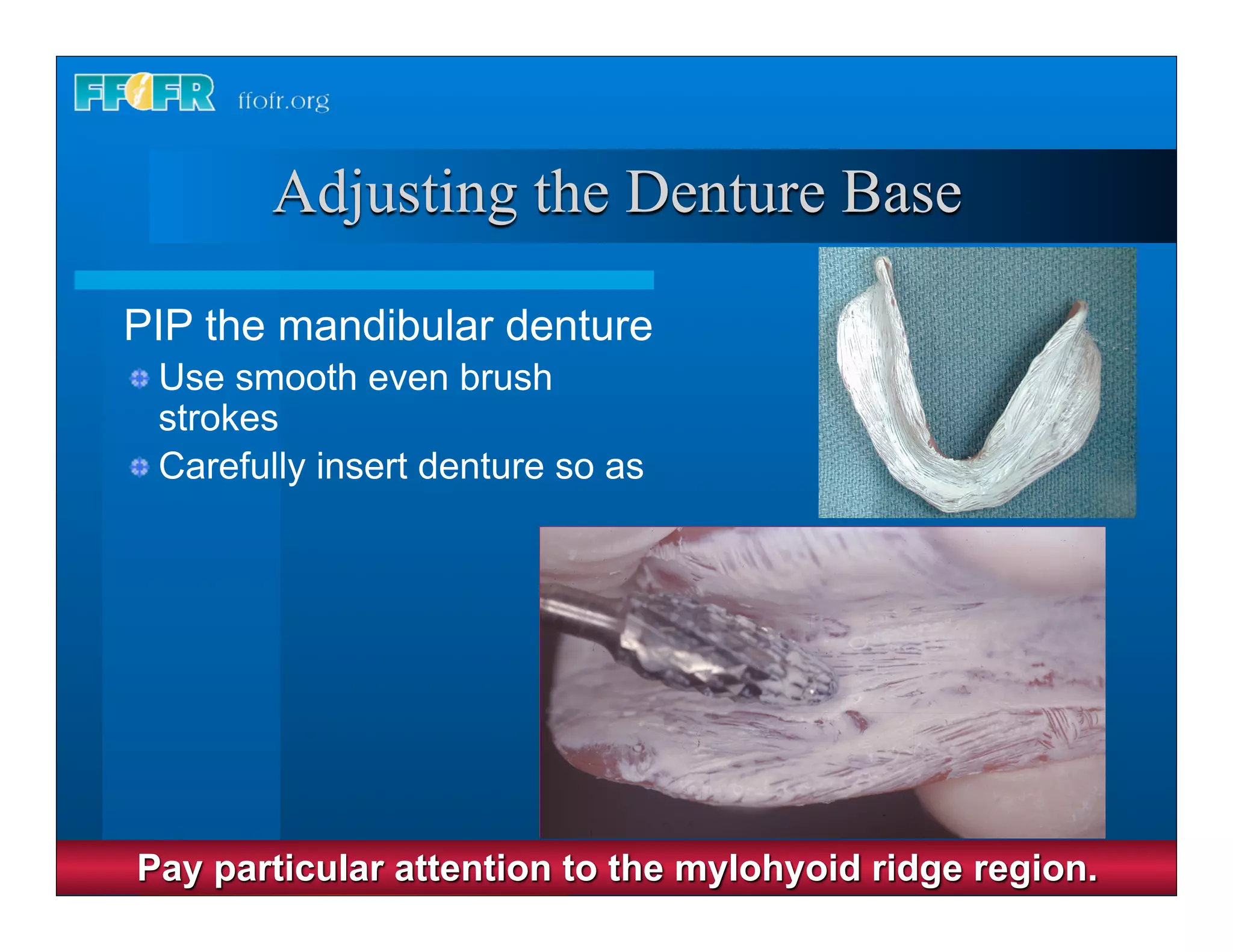 Complete dentures 30. insertion and followup | PPT