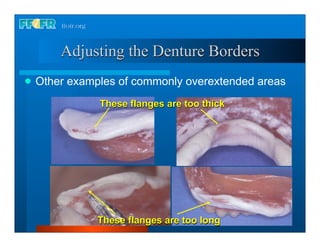Complete dentures 30. insertion and followup | PDF