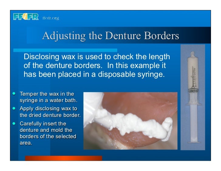 Complete dentures 30. insertion and followup