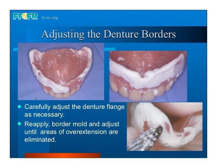 Complete Dentures 30 Insertion And Followup Complete Dentures 30 Insertion And Followup 13 728 