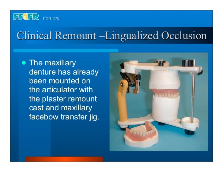 Complete dentures 30. insertion and followup