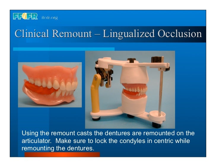 Complete dentures 30. insertion and followup