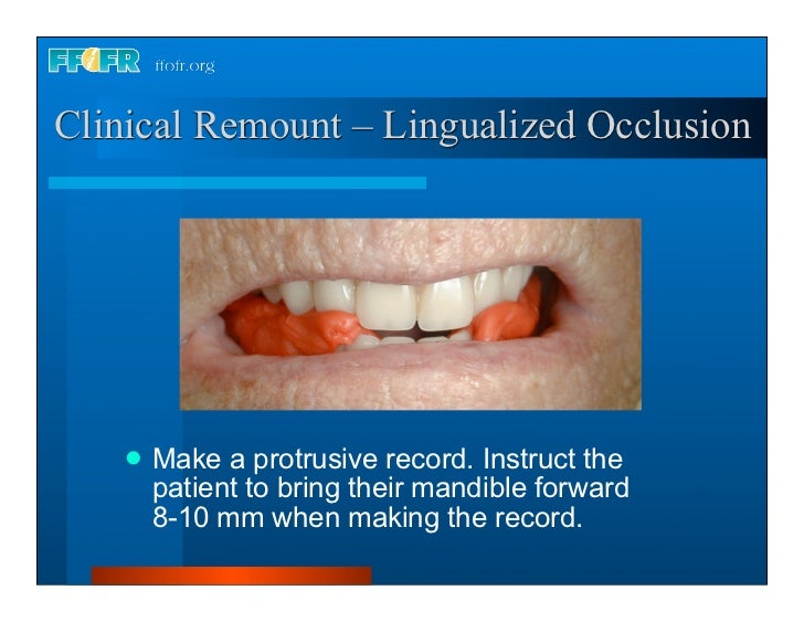 Complete dentures 30. insertion and followup