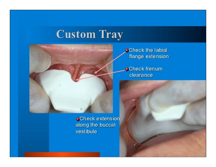 Complete dentures 7. final impressions