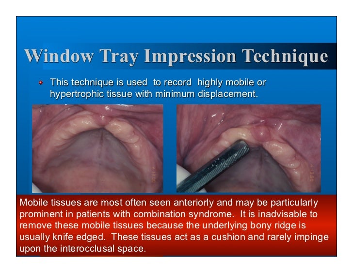 Complete dentures 7. final impressions