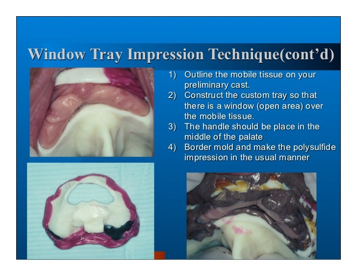 Complete dentures 7. final impressions