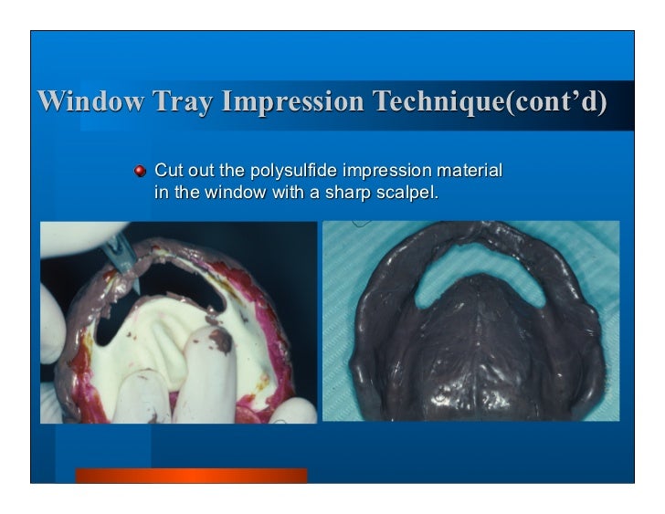 Complete dentures 7. final impressions
