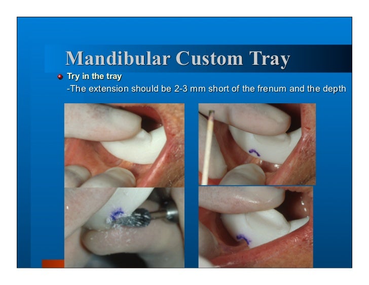 Complete dentures 7. final impressions