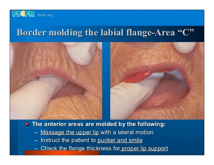 Complete dentures 7. final impressions