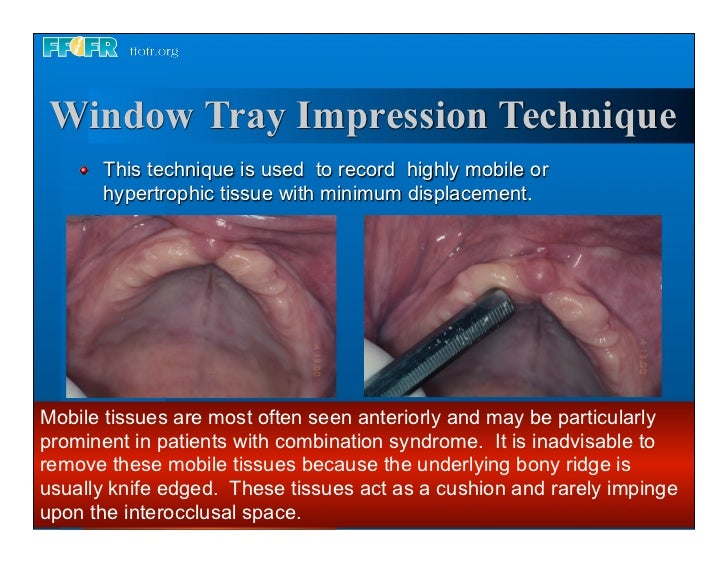 Complete dentures 7. final impressions