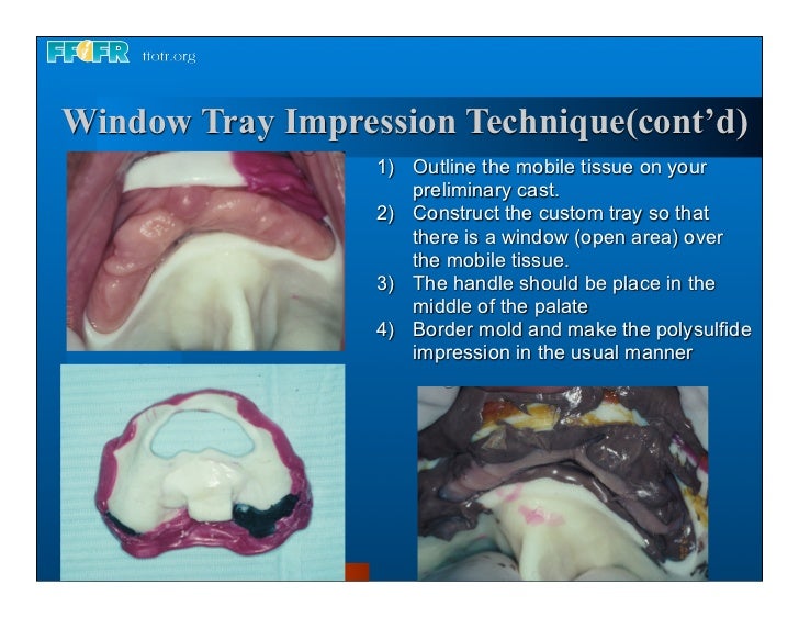 Complete dentures 7. final impressions