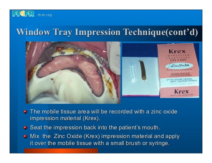 Complete dentures 7. final impressions