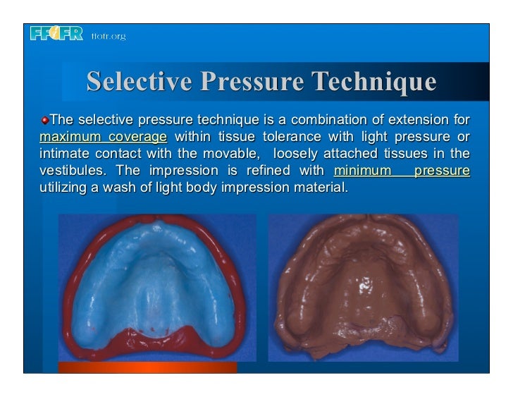 Complete dentures 7. final impressions