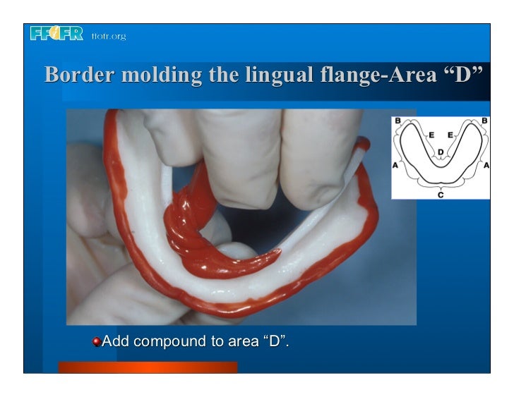Complete dentures 7. final impressions