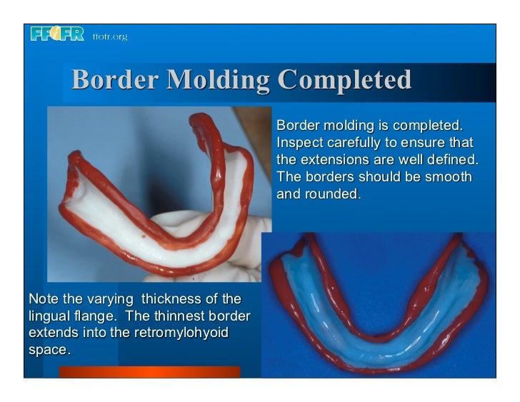 dentures denture