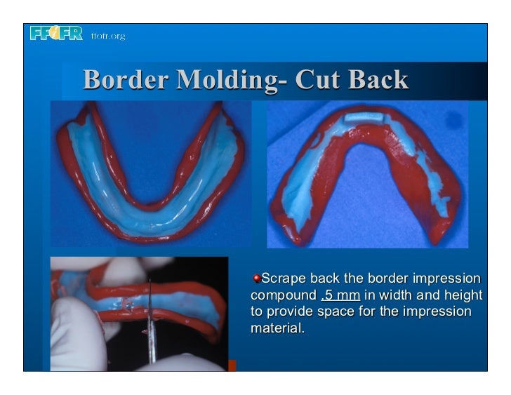Complete dentures 7. final impressions