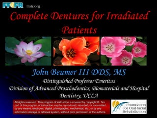 Complete dentures for irradiated patients
