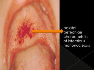 palatal
petechiae
charecteristic
of infectious
mononucleosis

 