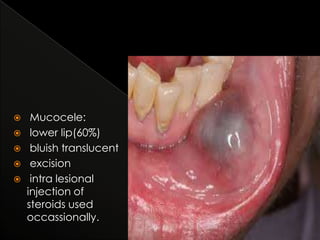 





Mucocele:
lower lip(60%)
bluish translucent
excision
intra lesional
injection of
steroids used
occassionally.

 