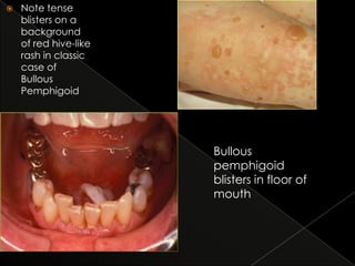 

Note tense
blisters on a
background
of red hive-like
rash in classic
case of
Bullous
Pemphigoid

Bullous
pemphigoid
blisters in floor of
mouth

 