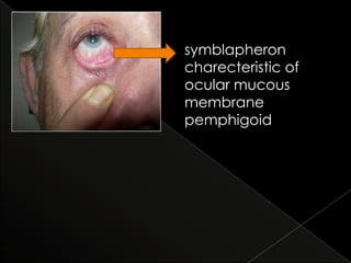 symblapheron
charecteristic of
ocular mucous
membrane
pemphigoid

 