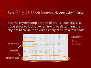 complete ECG interpretation presentation.ppt