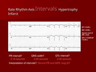 complete ECG interpretation presentation.ppt